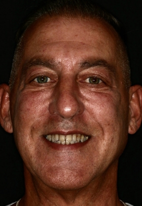 Porcelain Veneers Before