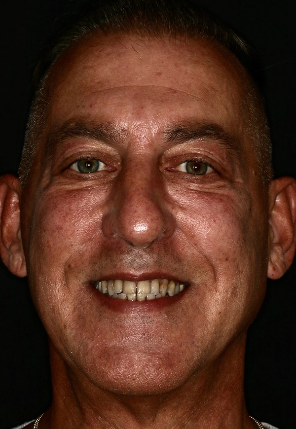 Porcelain Veneers Photos NYC - Portrait Before Men Patient 41