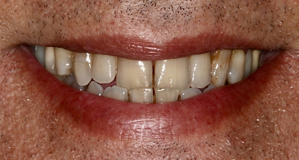 Porcelain Veneers Photos NYC - Smile Before Men Patient 41