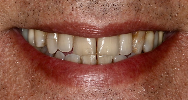 porcelain veneers before