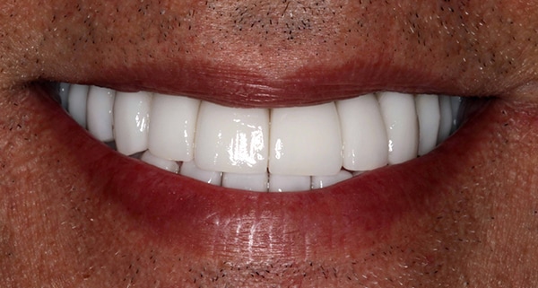 porcelain veneers after