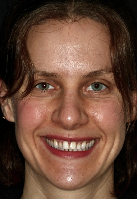 Porcelain Veneers Before