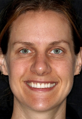 Porcelain Veneers After