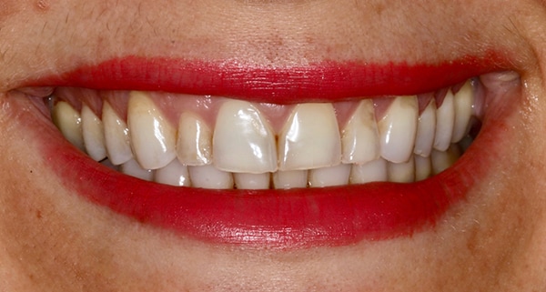 porcelain veneers before