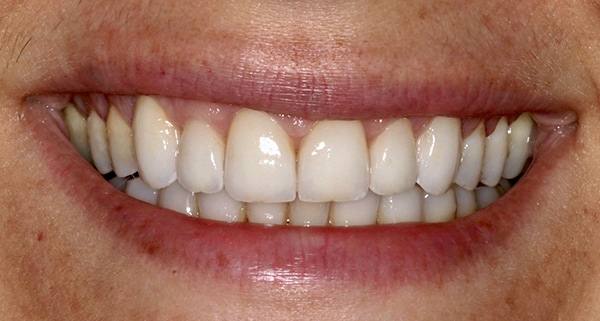 porcelain veneers after