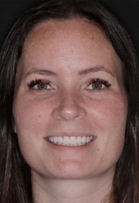 Porcelain Veneers After