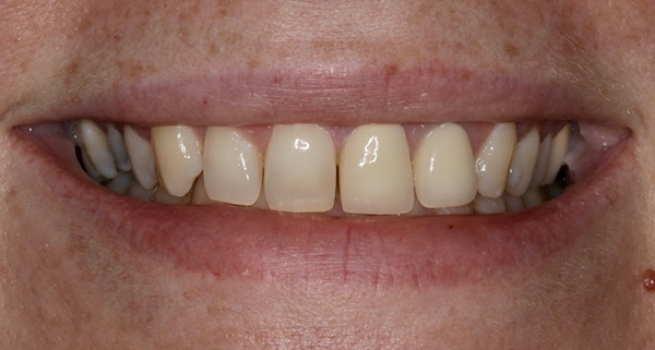 porcelain veneers before