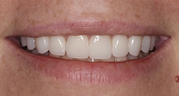 porcelain veneers after