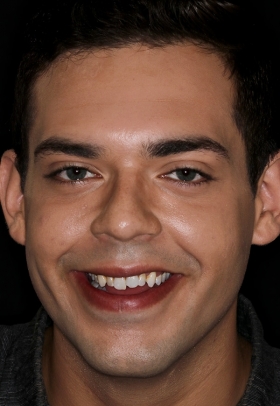 Porcelain Veneers Before