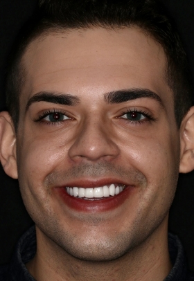 Porcelain Veneers After