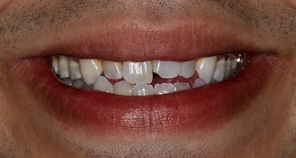 porcelain veneers before