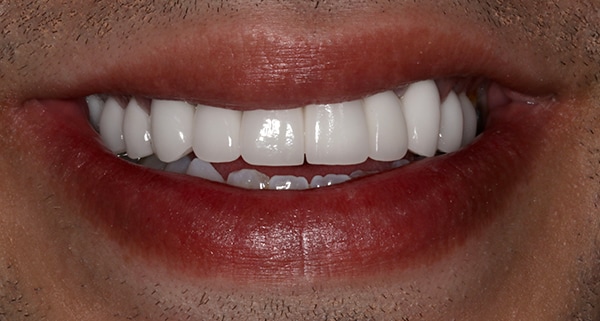 porcelain veneers after