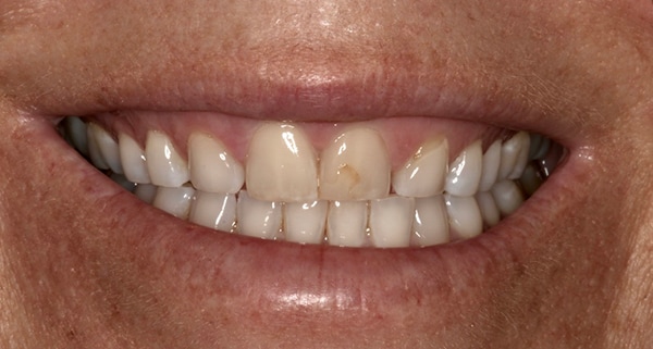 Porcelain Veneers Photos NYC - Smile Before Natural Smiles Patient 23