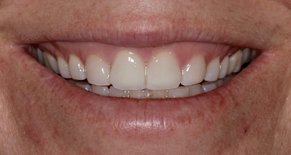 porcelain veneers after