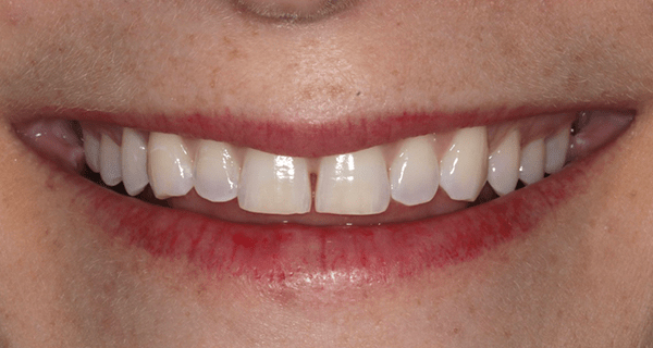 porcelain veneers before