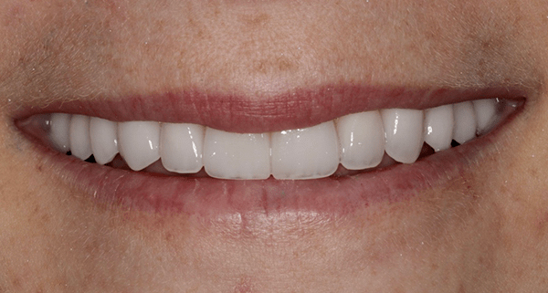 porcelain veneers after