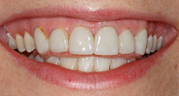 porcelain veneers before