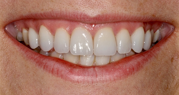 porcelain veneers after