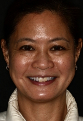 Porcelain Veneers Before