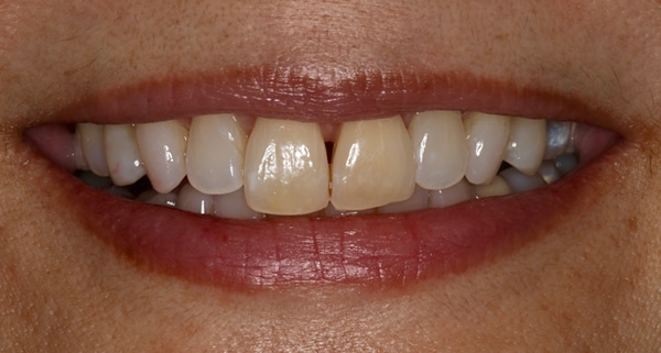 porcelain veneers before