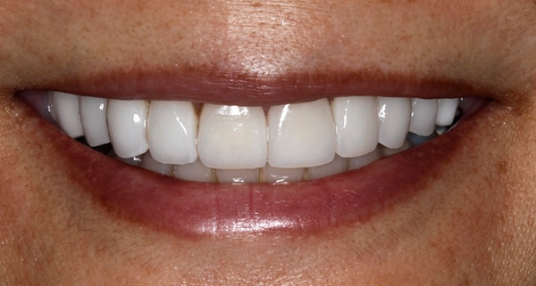 porcelain veneers after