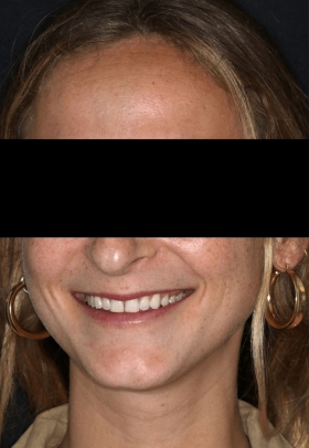 Porcelain Veneers Before