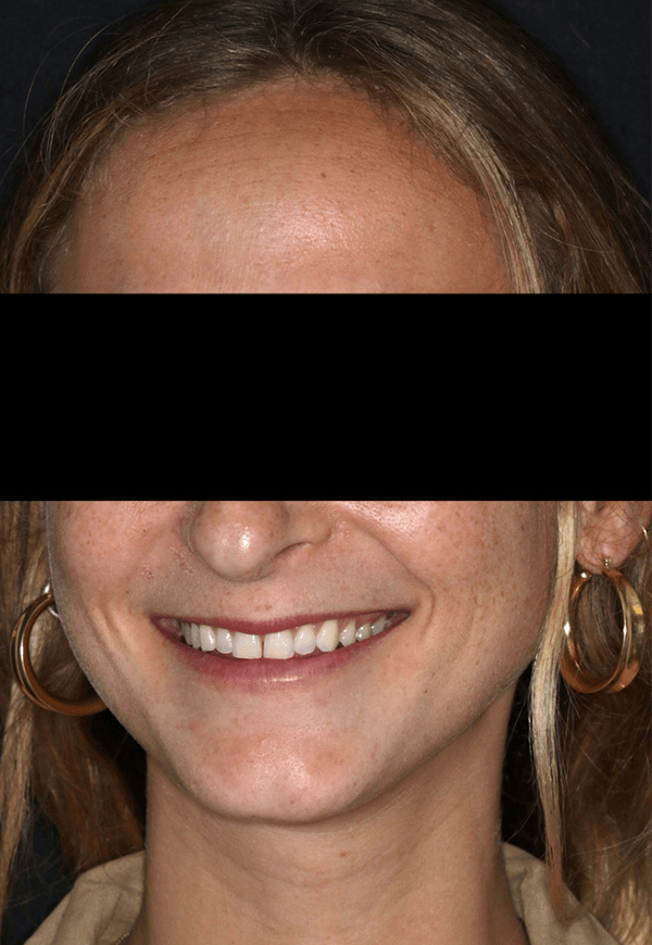 Porcelain Veneers Photos NYC - Portrait Before Women Patient 77