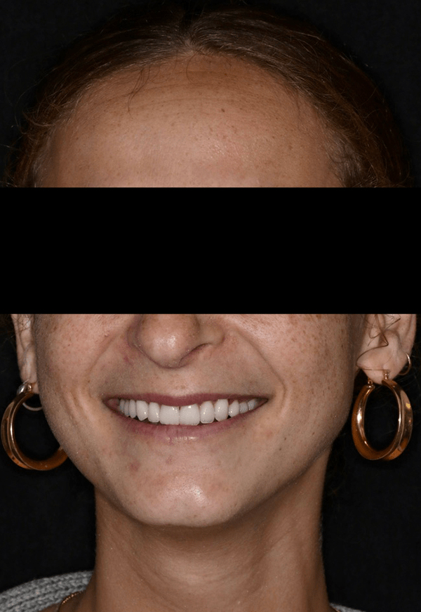 porcelain veneers after