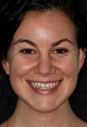 Porcelain Veneers Before