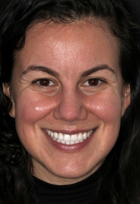 Porcelain Veneers After