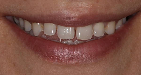 porcelain veneers before