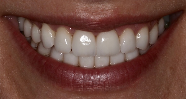 porcelain veneers after