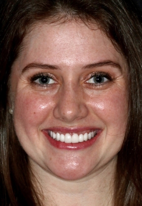 Porcelain Veneers After