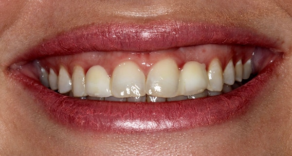 porcelain veneers before