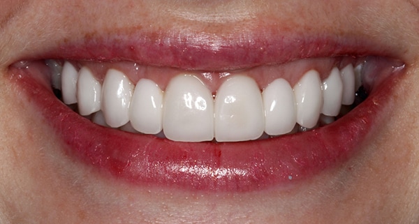 porcelain veneers after