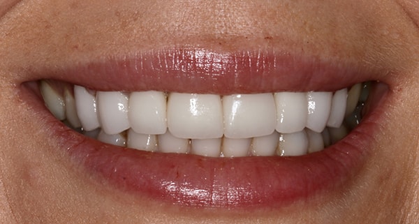 porcelain veneers after