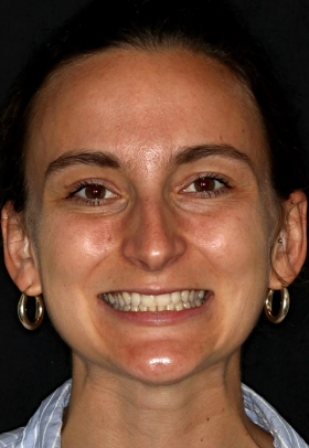 Porcelain Veneers Before