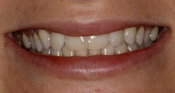 porcelain veneers before