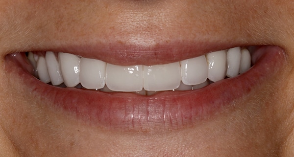 porcelain veneers after