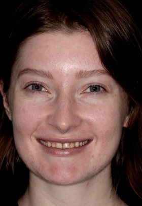 Porcelain Veneers Before