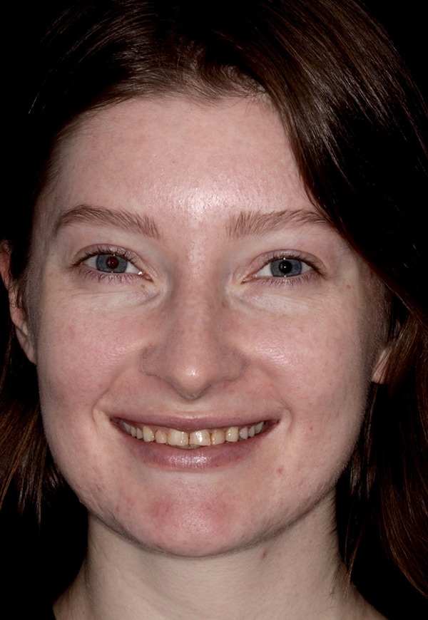 Porcelain Veneers Photos NYC - Portrait Before Women Patient 83