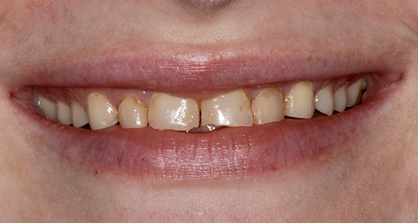 porcelain veneers before