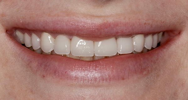 porcelain veneers after