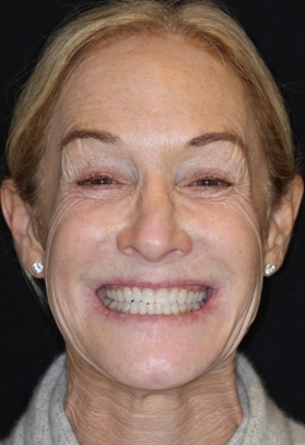 Porcelain Veneers Before