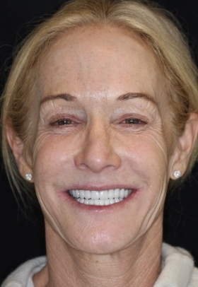 Porcelain Veneers After