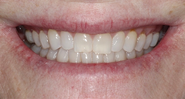 porcelain veneers before