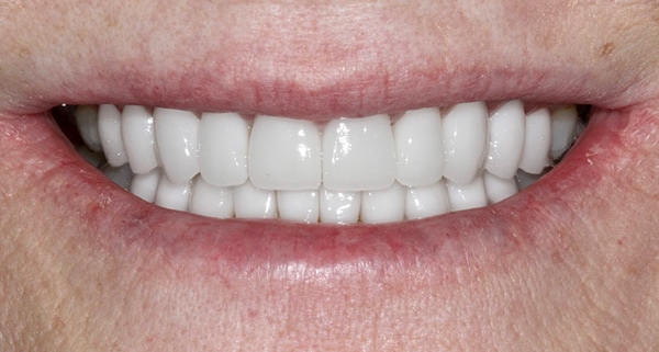 porcelain veneers after