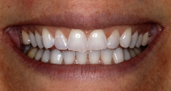 porcelain veneers before