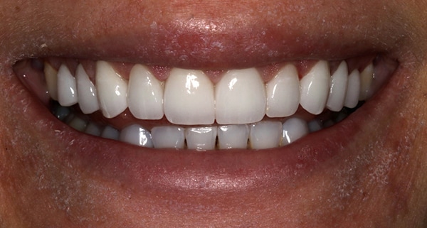 porcelain veneers after