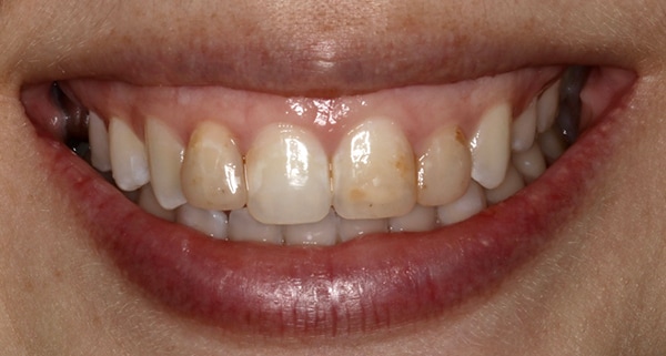 porcelain veneers before